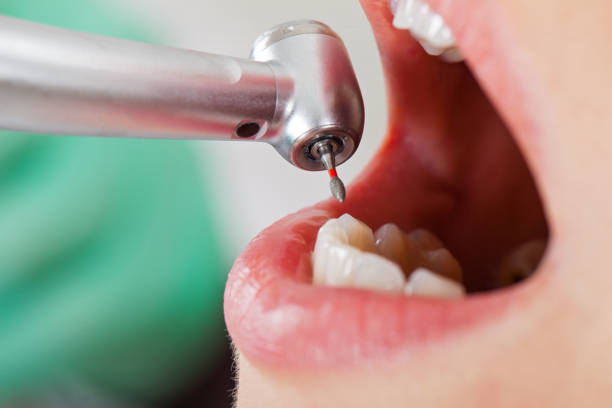 Best Emergency Tooth Extraction in Kualapuu, HI